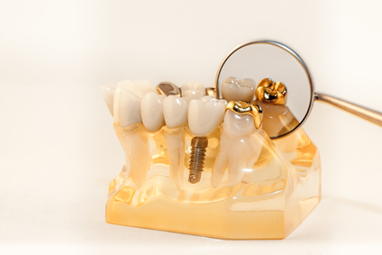 Dental Scrap Gold