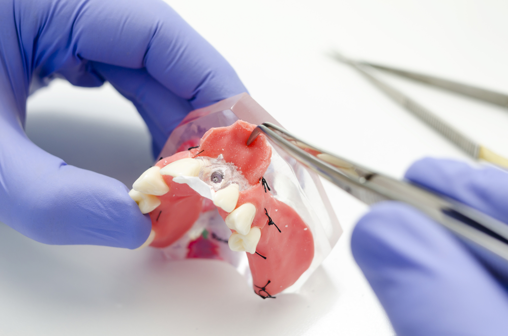choosing the right dental materials