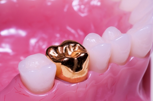 gold front tooth crown